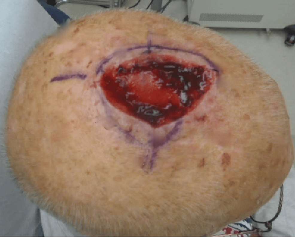 bolster dressing Retrospective Study on the Clinical Superiority of the Vacuum-Assisted Closure System with a Silicon-Based Dressing over the Conventional Tie-over Bolster Technique in Skin Graft Fixation