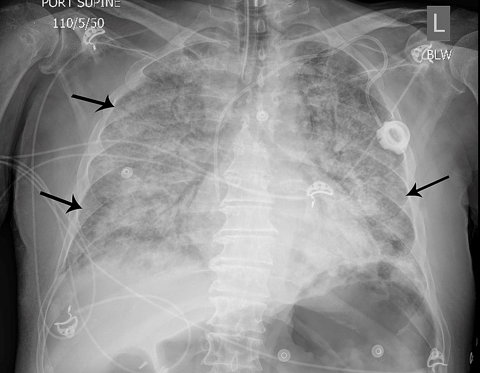 Cureus A Rare Case of Irinotecaninduced Interstitial Pulmonary