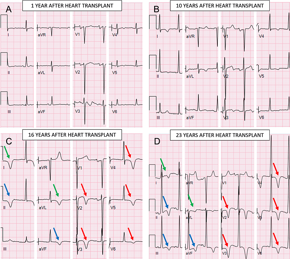 Cureus  Left Ventricular Global Longitudinal Strain in Patients