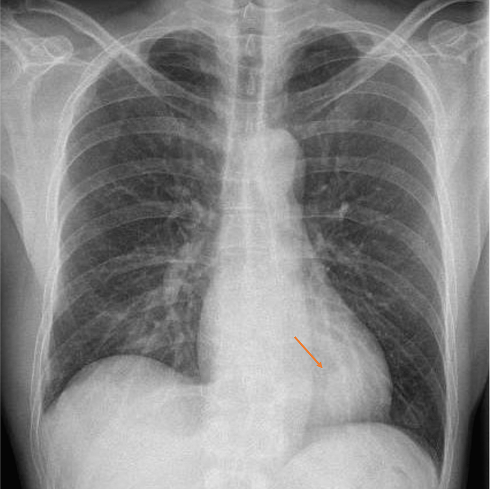 cryptogenic-acute-fibrinous-and-organizing-pneumonia-a-case-report