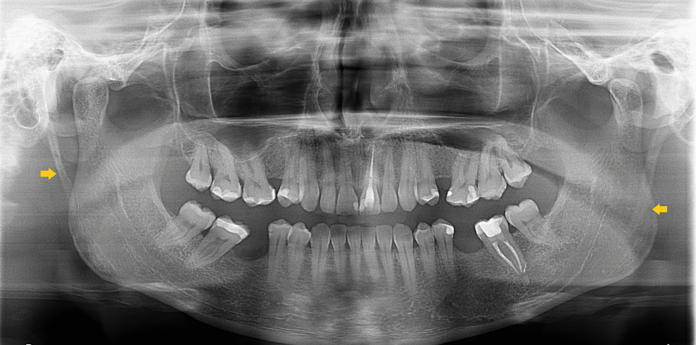 Cureus | Recurrent Syncope Related to Carotid Compression in Eagle ...