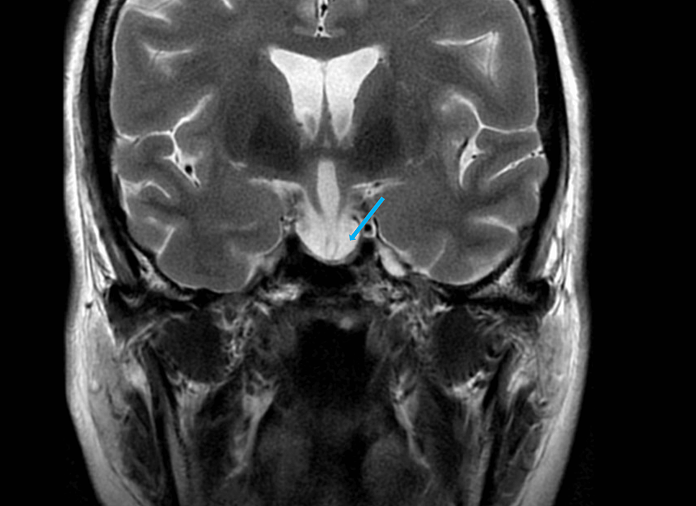 Severe Hyponatremia In A 46 Year Old Female With Pituitary Stalk Duplication And Primary Empty 4210