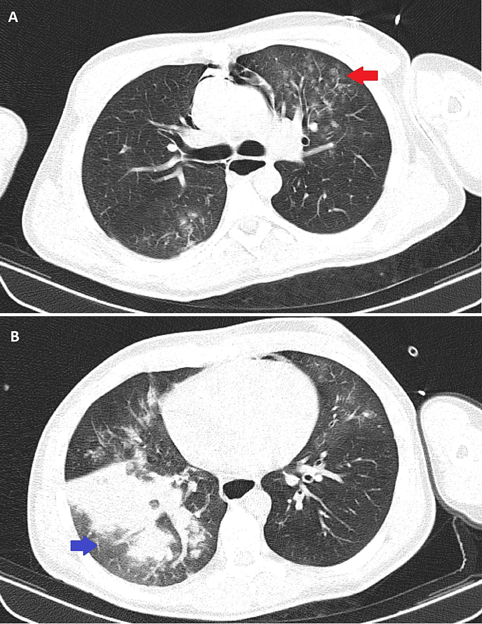 Cureus | Wolfram Syndrome: A Curious Case of Repetitive Loss of ...