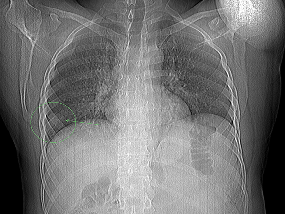 Cureus Bilateral Deep Vein Thrombosis (DVT) as a Harbinger of Lung