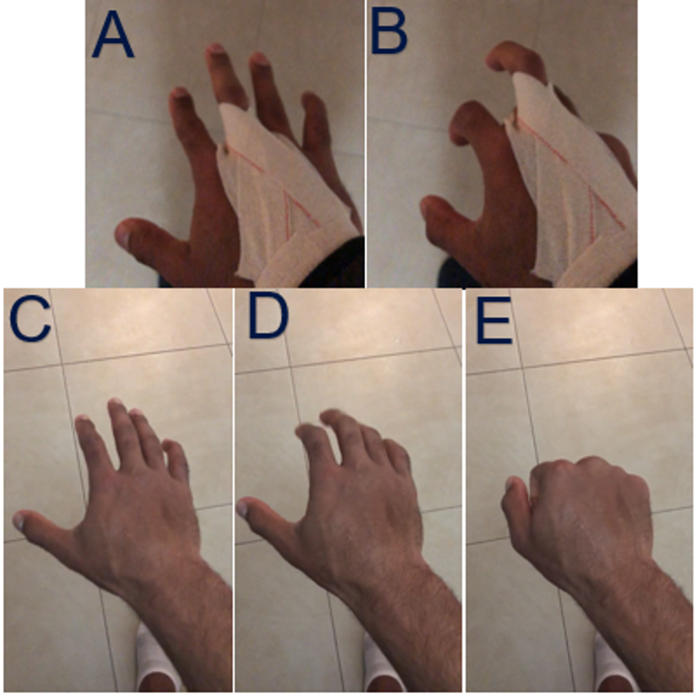 Cureus | Multiple Bony Mallet Finger Injuries in One Hand of a 14-Year-Old  Boy | Article
