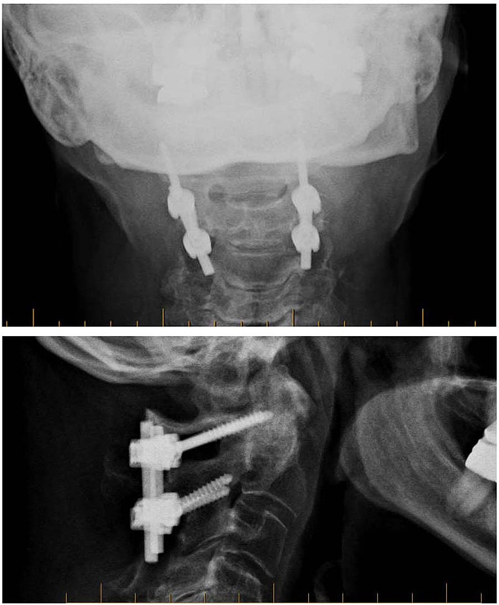 Cureus Application Of The Harms Technique To Treat Undiagnosed