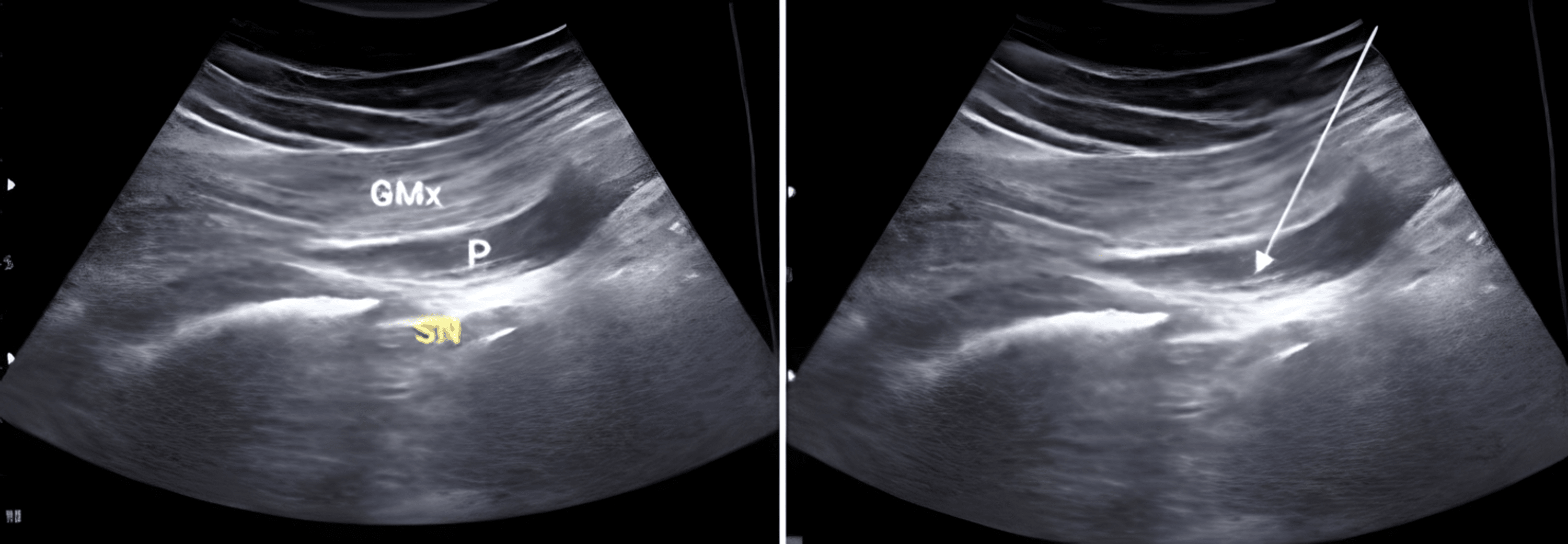 Cureus Evaluation of the Efficacy of UltrasoundGuided Dry Needling Therapy and Exercise in