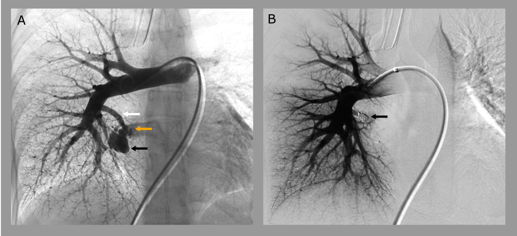 Cureus Pulmonary Arteriovenous Malformations A Rare Cause of