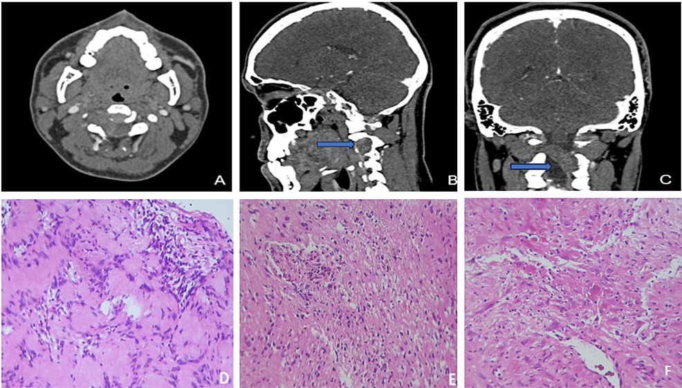 melanotic schwannoma chinese name File:Psammomatous - very high mag.jpg Malignant melanotic schwannoma of the