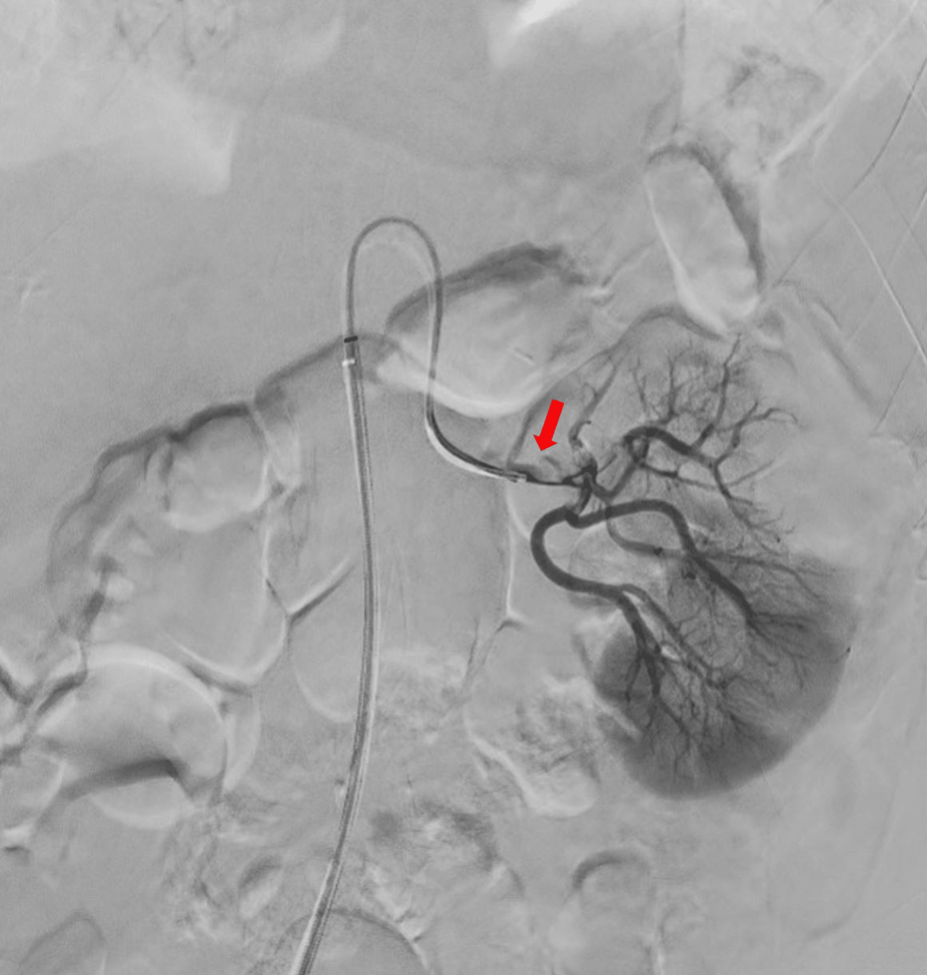 Spontaneous Renal Artery Thrombosis An Unusual Cause of Acute
