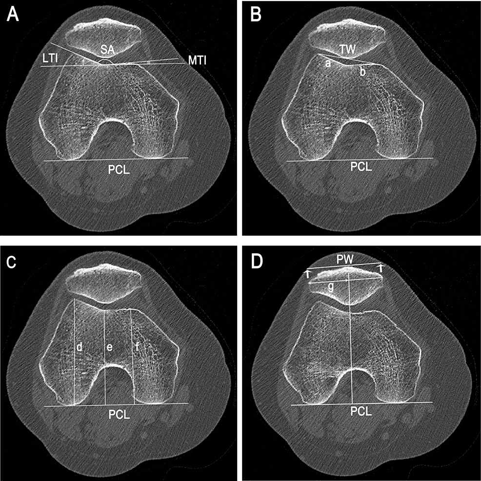 Zastosowanie ortogonalnej fluoroskopii dupleksowej i tomografii do oceny związku między morfologią stawu kolanowego a kinematyką rzepki u pacjentów z bólem rzepkowo-udowym.