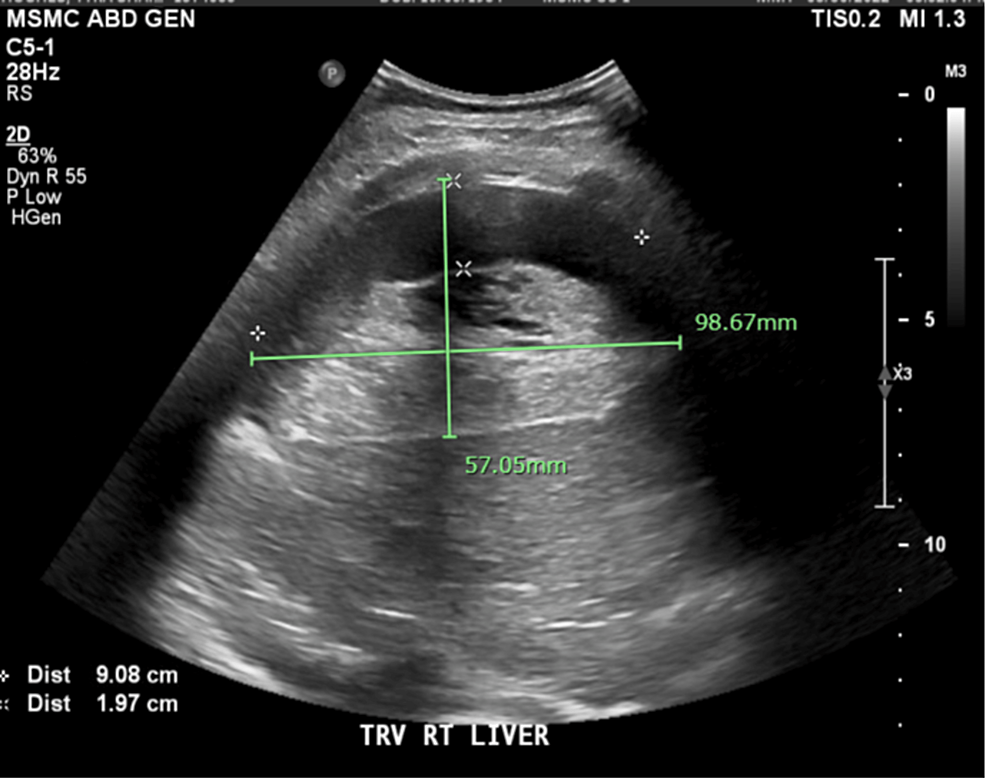 Cureus, The Conservative Management of an Uncommon Case of Postpartum  HELLP (Hemolysis, Elevated Liver Enzymes, and Low Platelet Count) Syndrome  Complicated by Liver Hematoma Causing Gastric Outlet Obstruction: A Case  Report