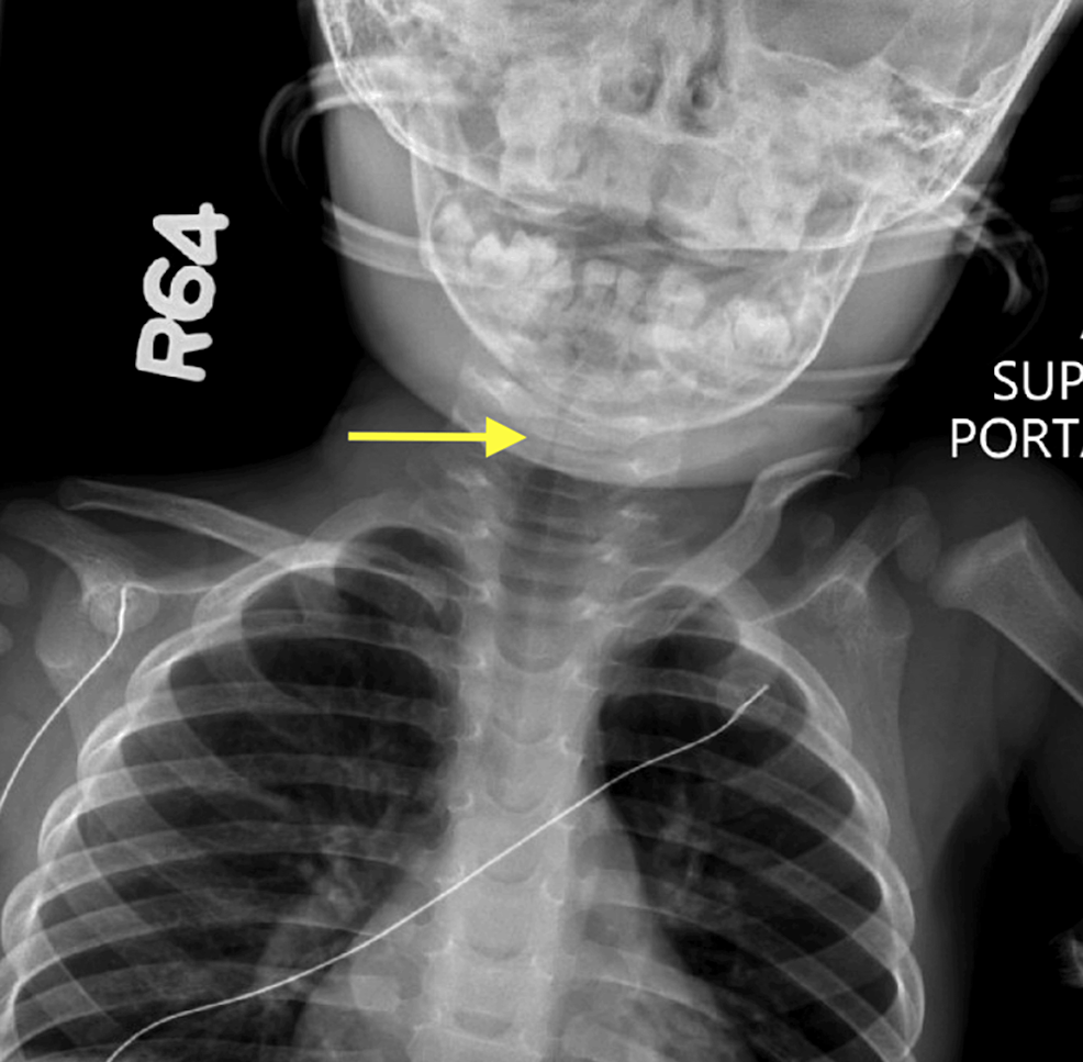 Cureus Recurrent Subglottic Stenosis in a 16MonthOld Male in the
