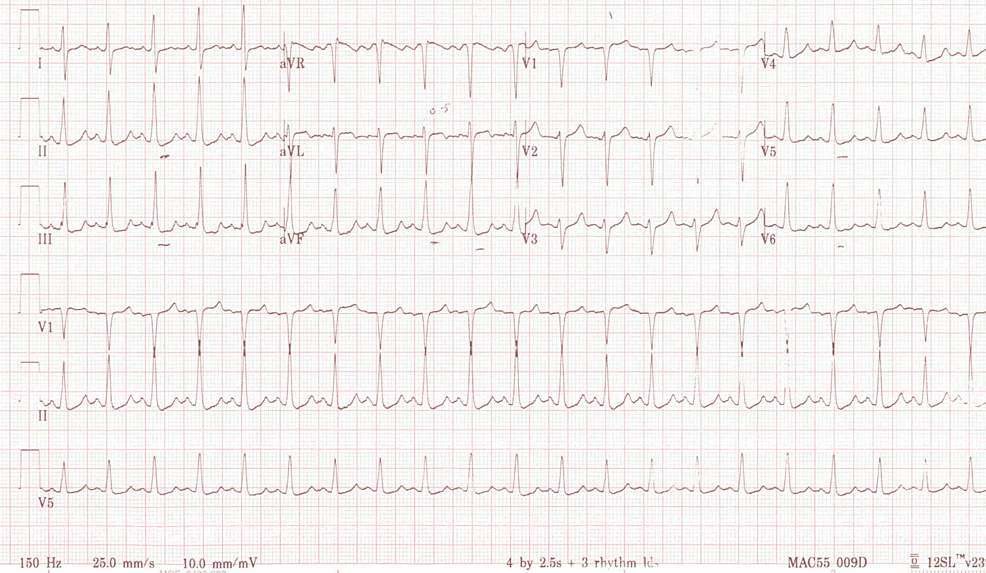 Cureus | A Case of Prolonged Recovery for Post-percutaneous Coronary ...