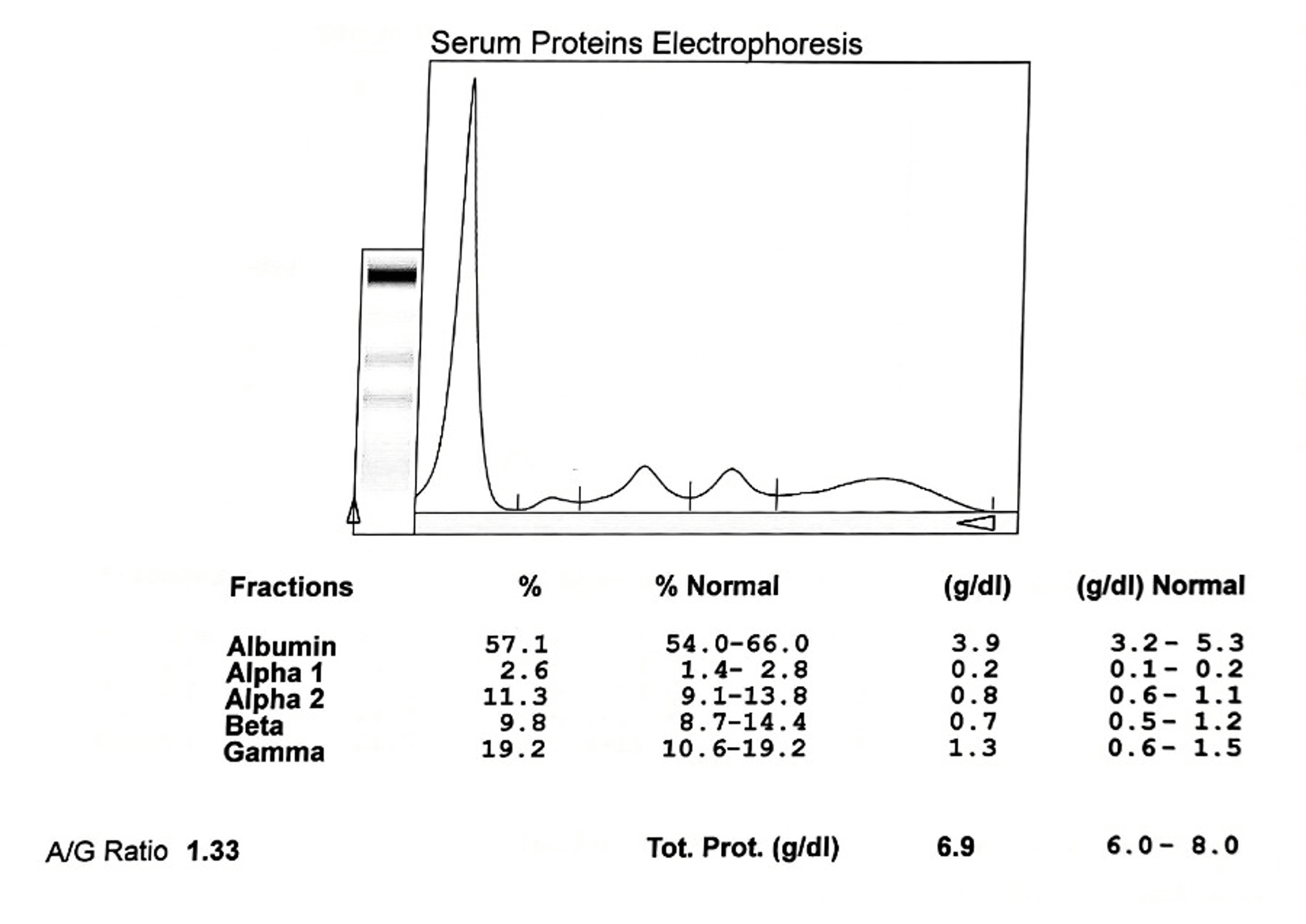 Cureus Serum Protein Electrophoresis Bands As Biomarkers for DrugSensitive Pulmonary Tuberculosis