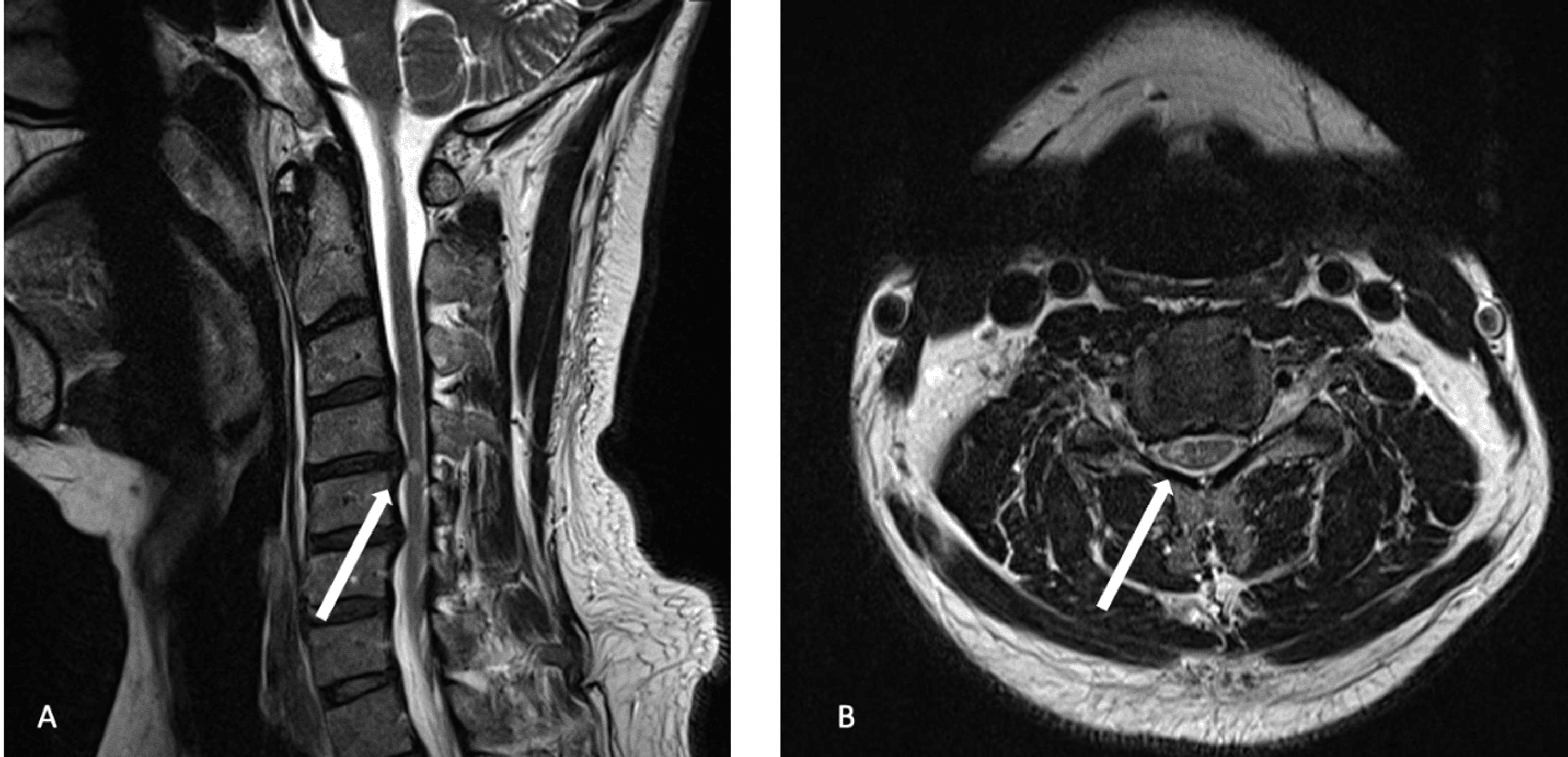 Utility of Flexion and Extension MRI for Evaluating Isolated Cervical Spinal Cord Lesions A