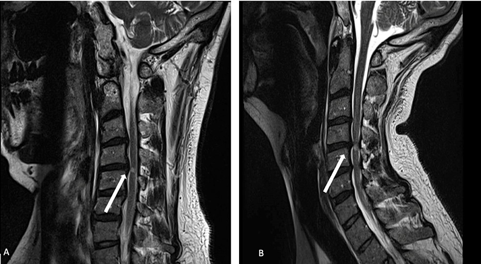 Utility of Flexion and Extension MRI for Evaluating Isolated Cervical
