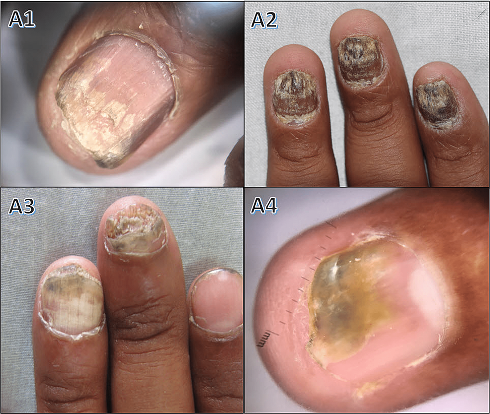 Pterygium in second and third fingernails in lichen pla | Open-i