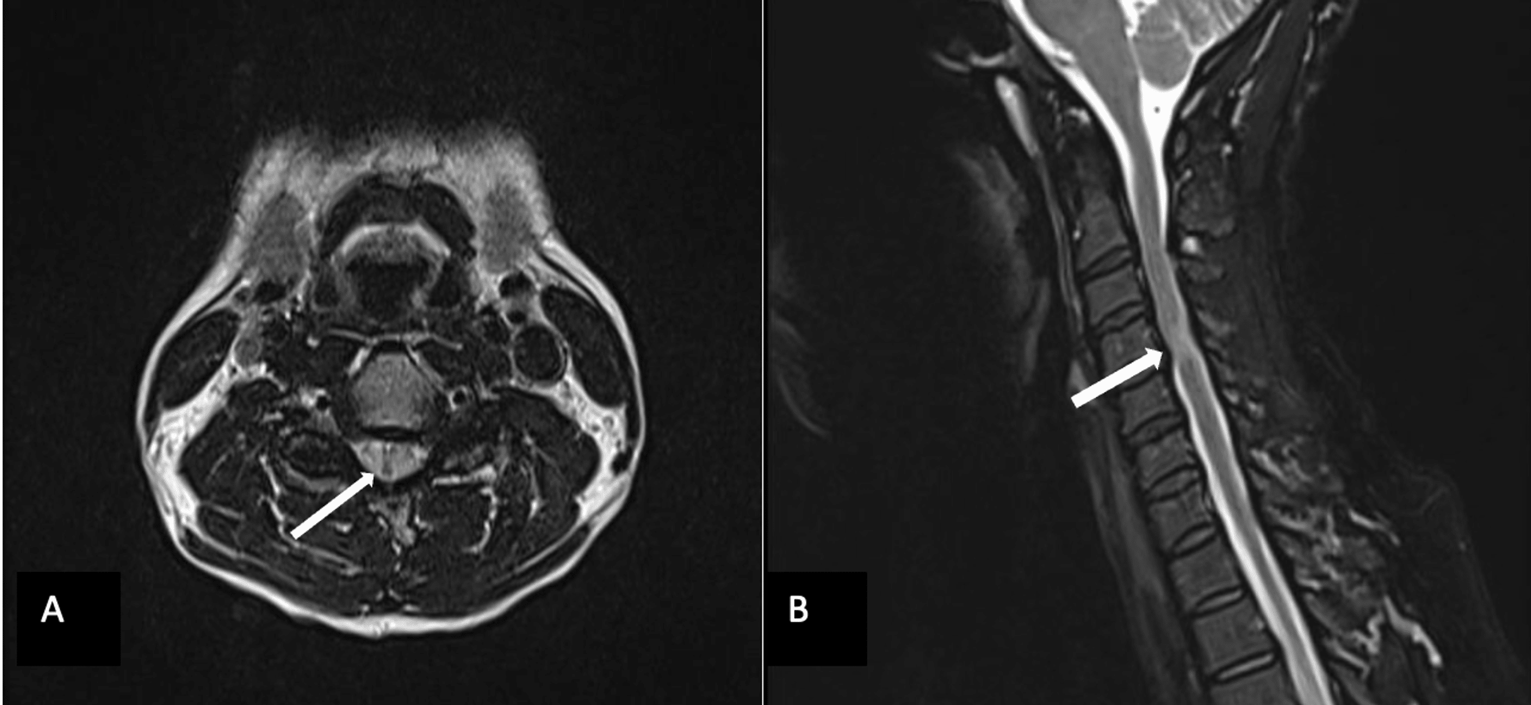 Utility of Flexion and Extension MRI for Evaluating Isolated Cervical