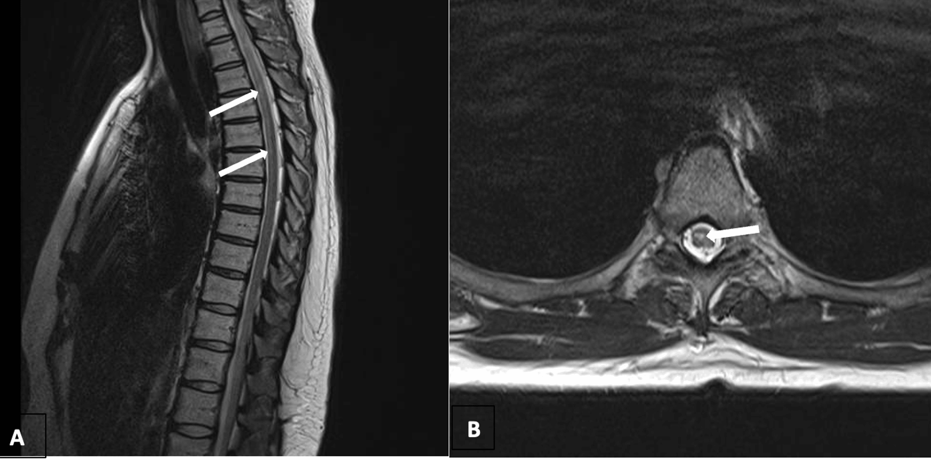 Utility of Flexion and Extension MRI for Evaluating Isolated Cervical