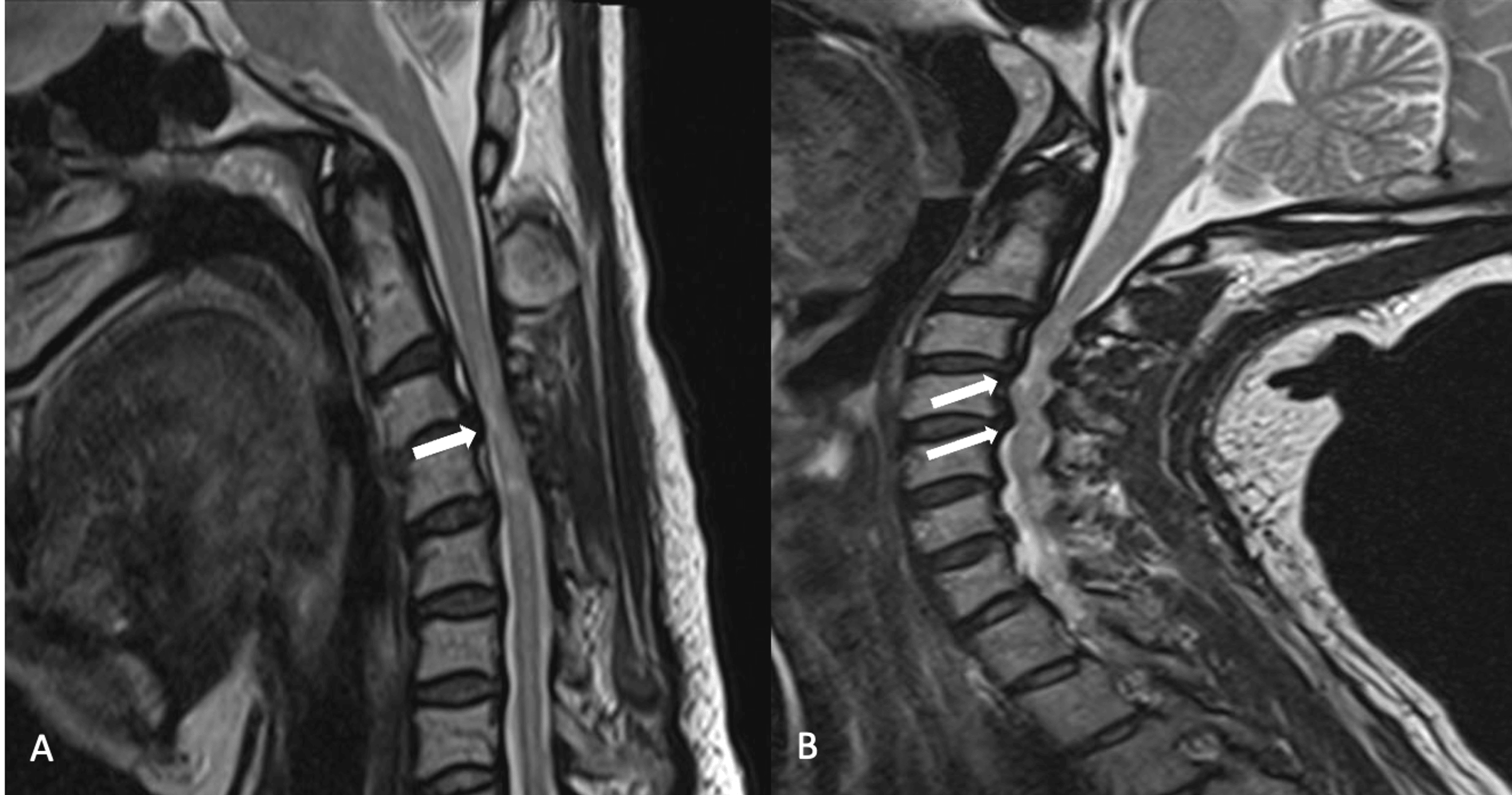 Cureus Utility of Flexion and Extension MRI for Evaluating Isolated