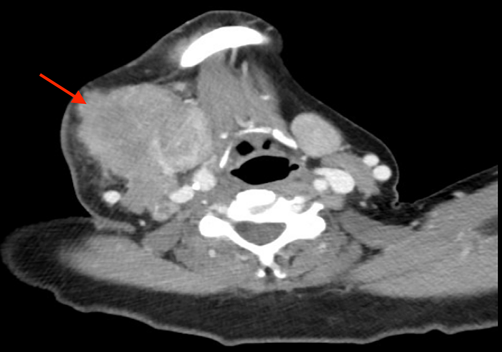 Cureus | An Unusual Case of Alveolar Rhabdomyosarcoma of the Neck in an