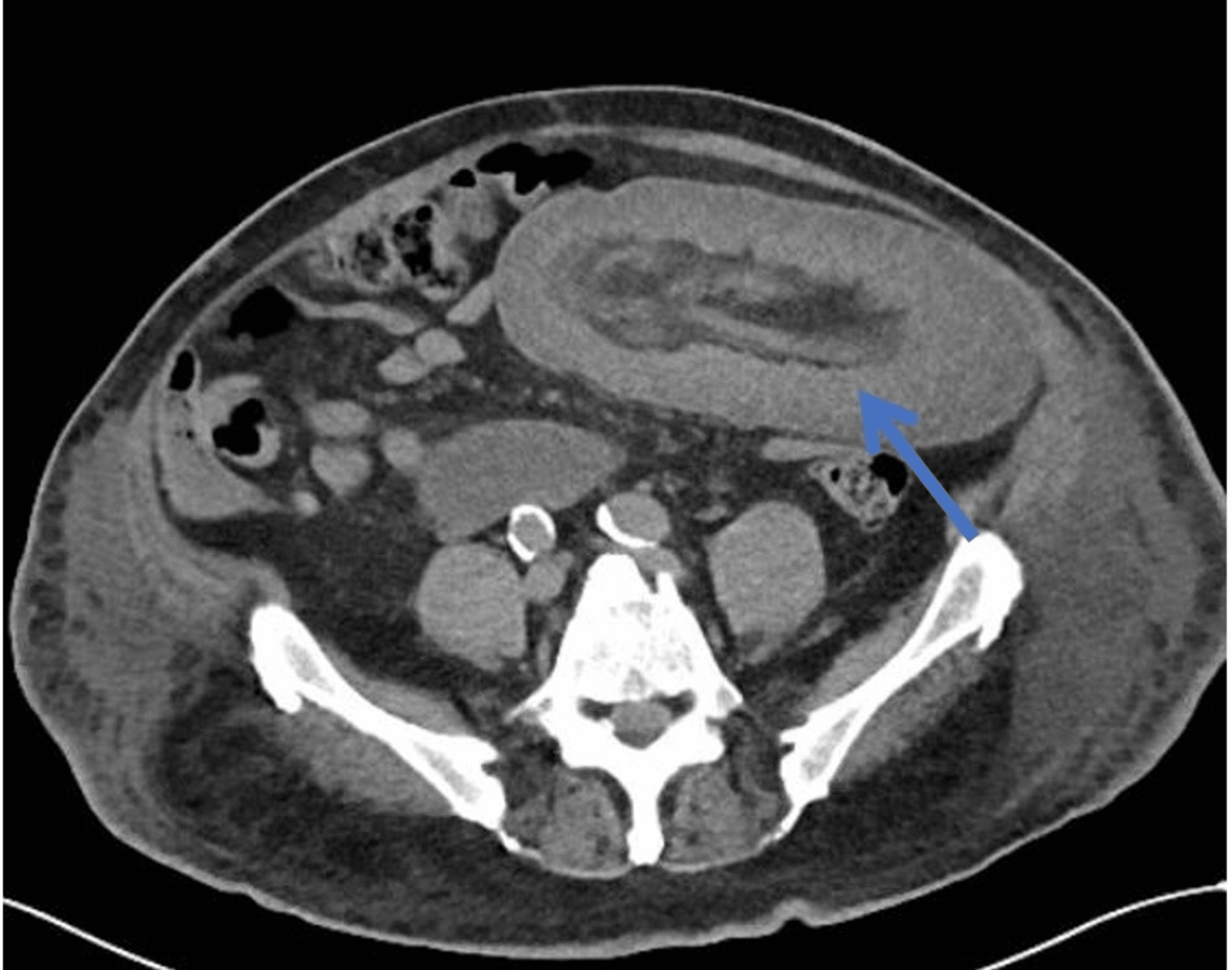 A Rare Case of Small Bowel Intussusception in an Elderly A Case Report
