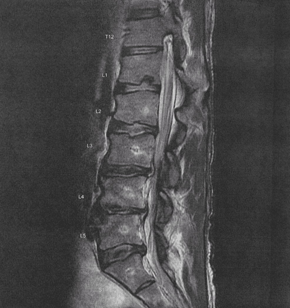 An Presentation of Cervical Myelopathy Cureus