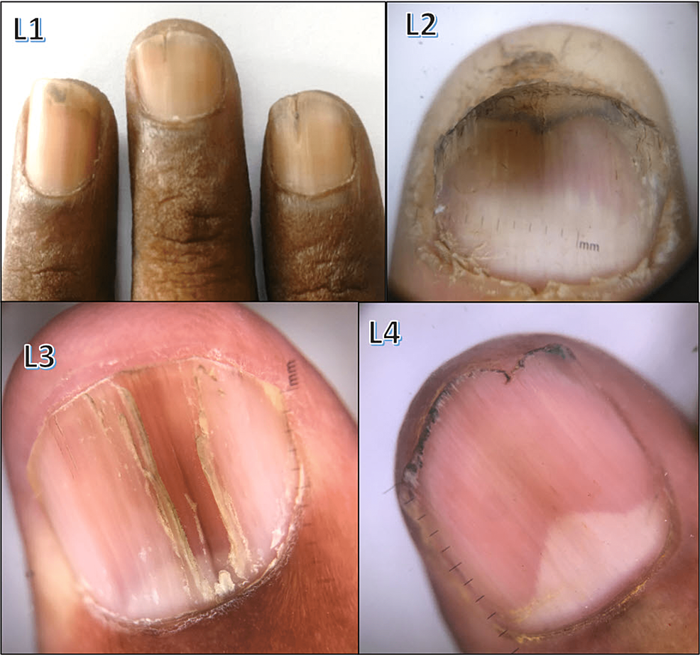 Nail Whispers Revealing Dermatological and Systemic Secrets An