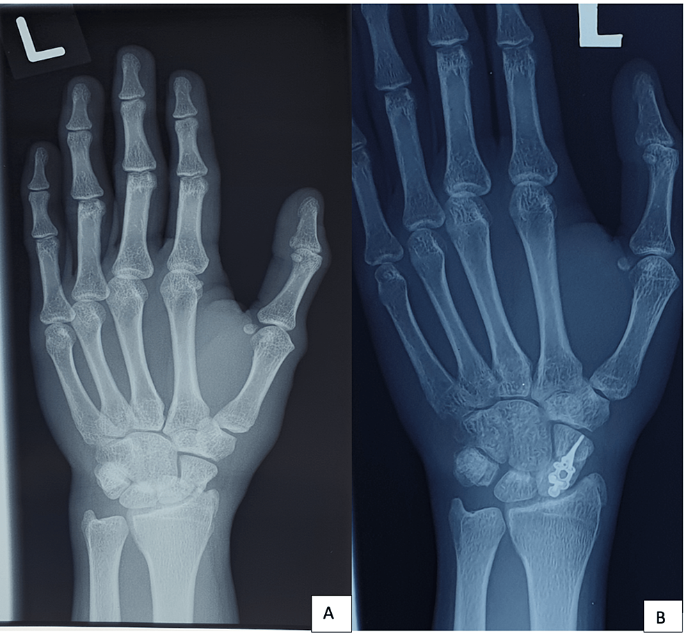 Bones in Wrist: A Comprehensive Guide - JOI Jacksonville Orthopaedic  Institute