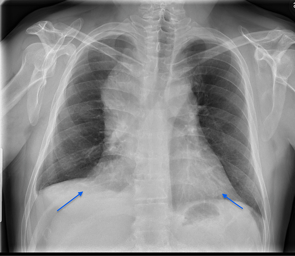 Cureus A Rare Case Of Non Small Cell Lung Carcinoma Complicated By
