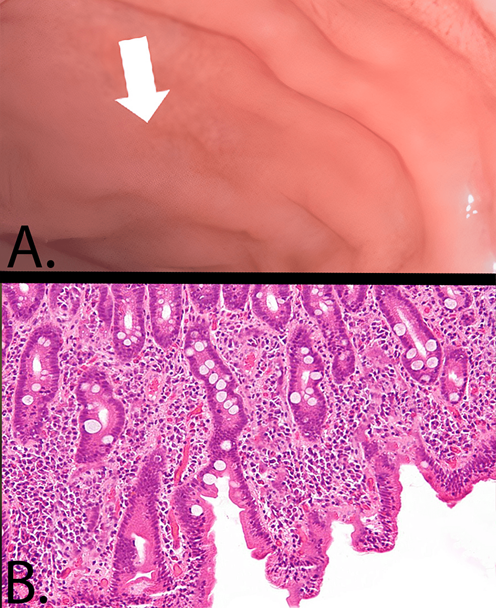 celiac-disease-and-your-oral-health-westermeier-martin-dental-care