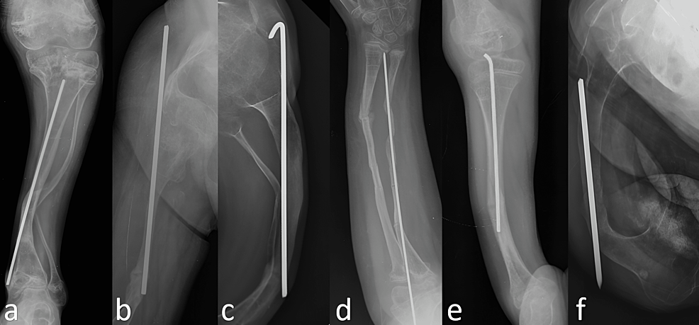 Cureus Complications After Intramedullary Fixation Treatment Of Patients With Osteogenesis 2973