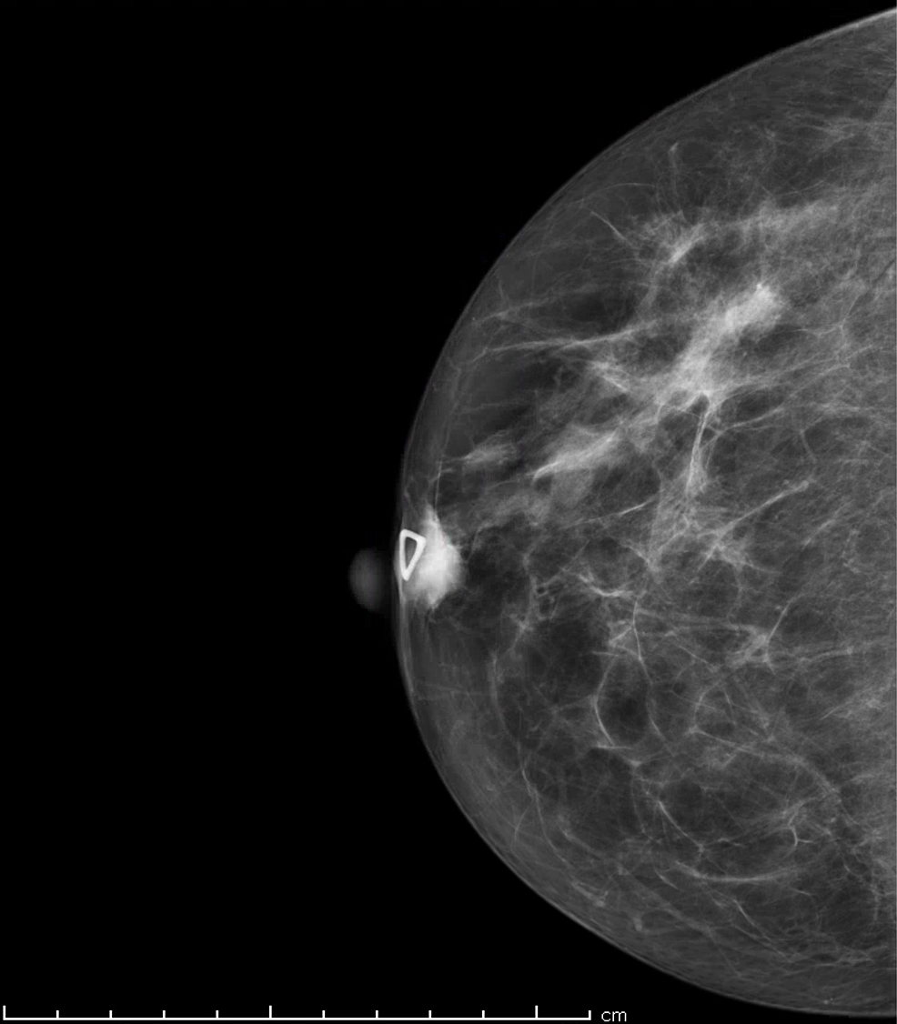 Cureus | Malignant Clear Cell Hidradenoma of the Breast | Article