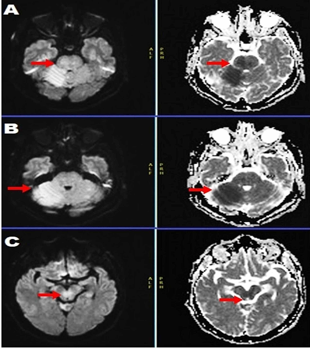 cureus-smog-sign-hazy-diffusion-weighted-imaging-restriction-in