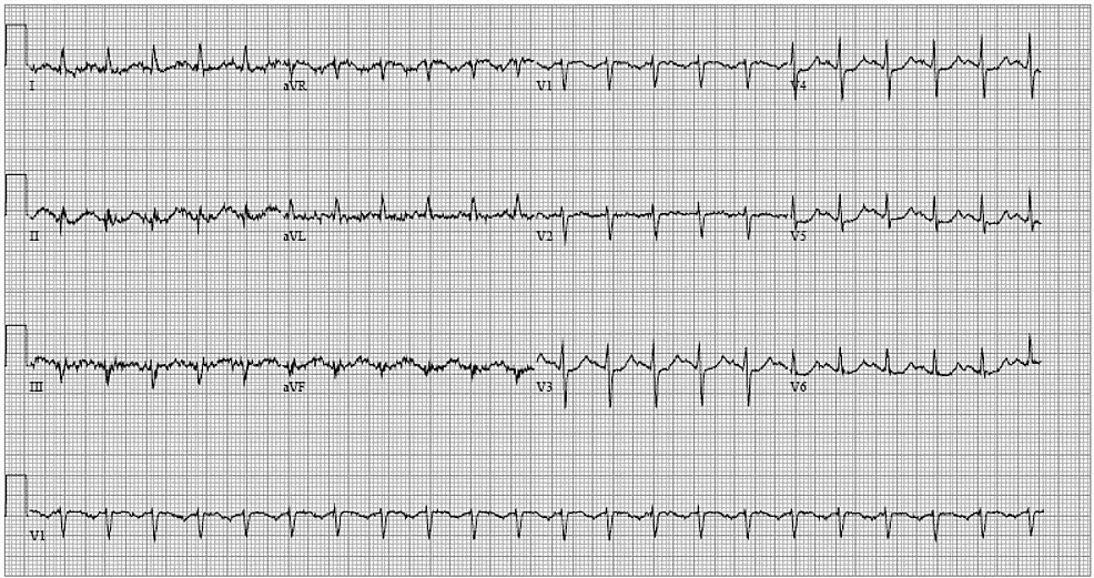 Incidentally Diagnosed Anomalous Right Coronary Artery with an ...