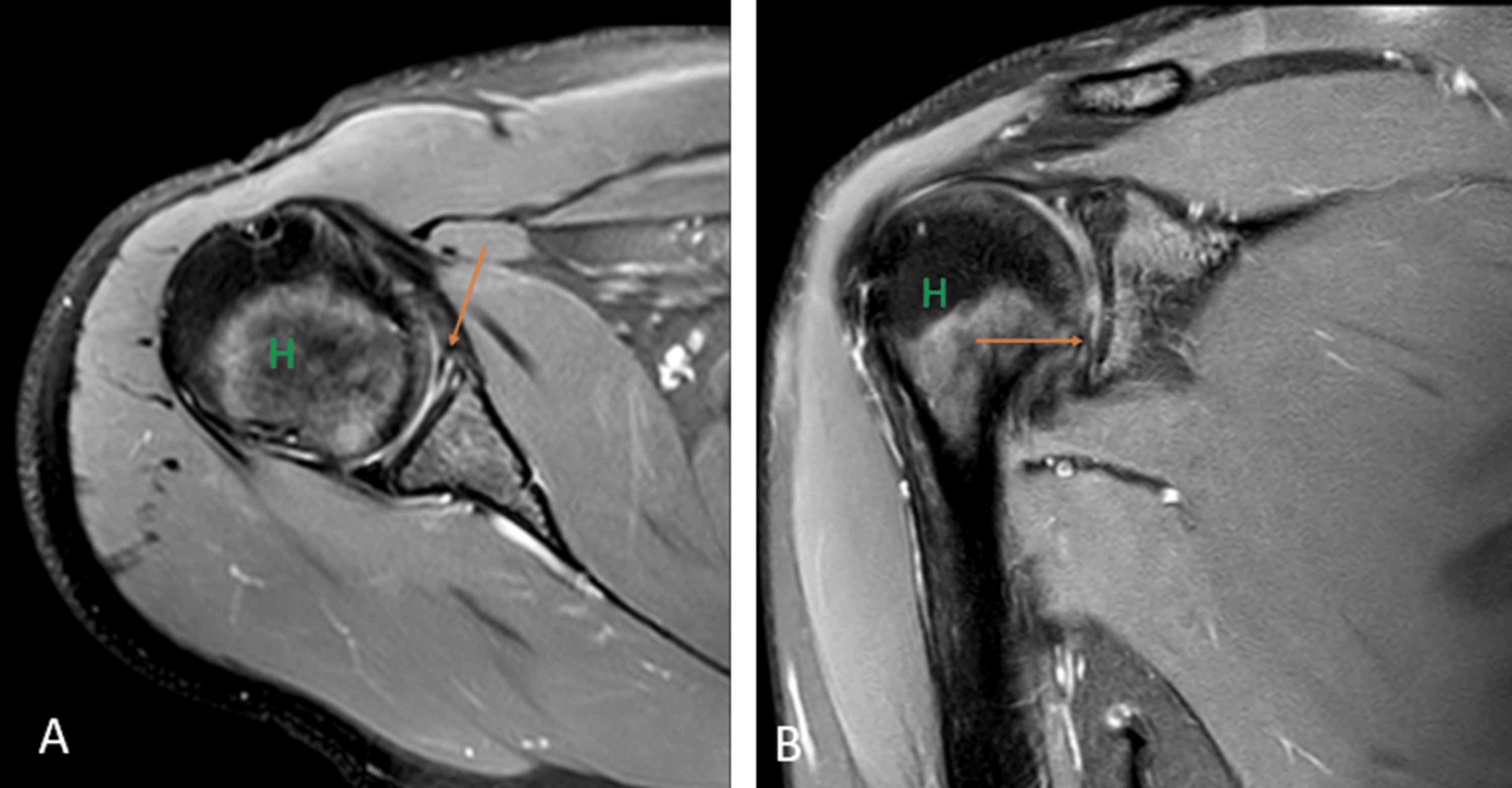 Cureus | The Spectrum of Shoulder Pathologies on Magnetic Resonance ...