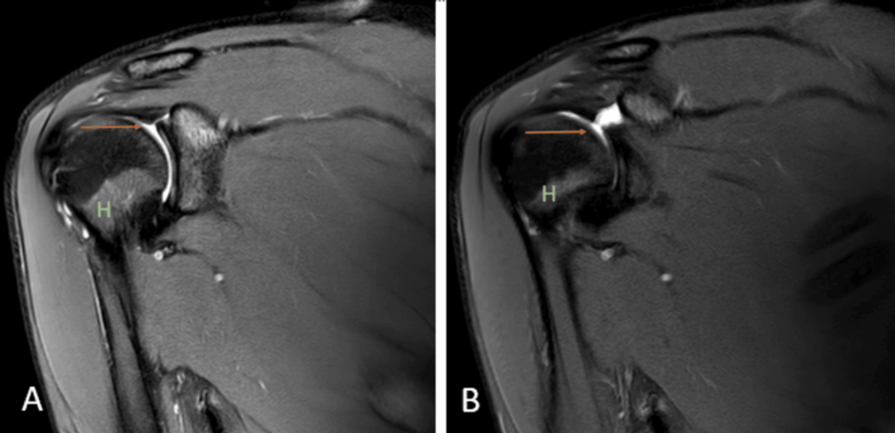 cureus-the-spectrum-of-shoulder-pathologies-on-magnetic-resonance