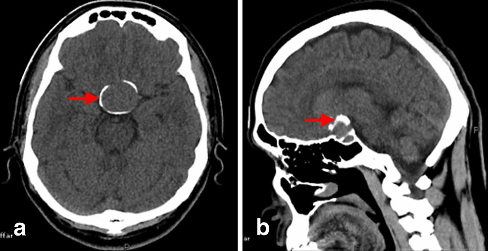 Craniopharyngioma And Pituitary Adenoma 