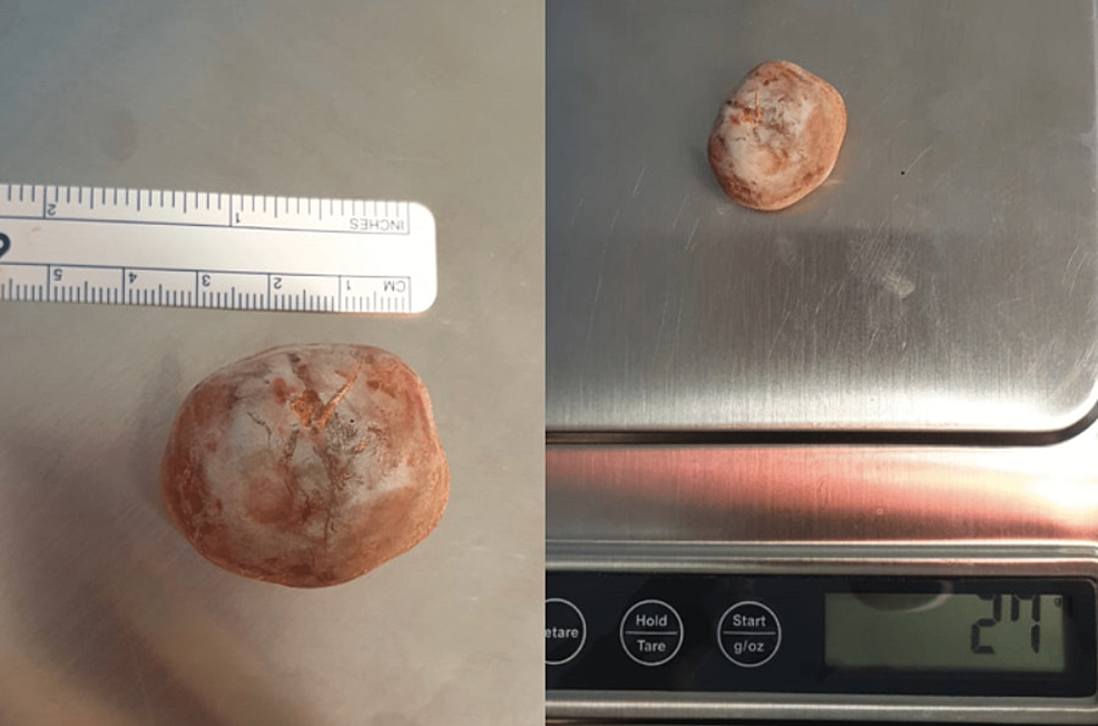 Vesical Calculi And Female Pelvic Organ Prolapse A Case Report And