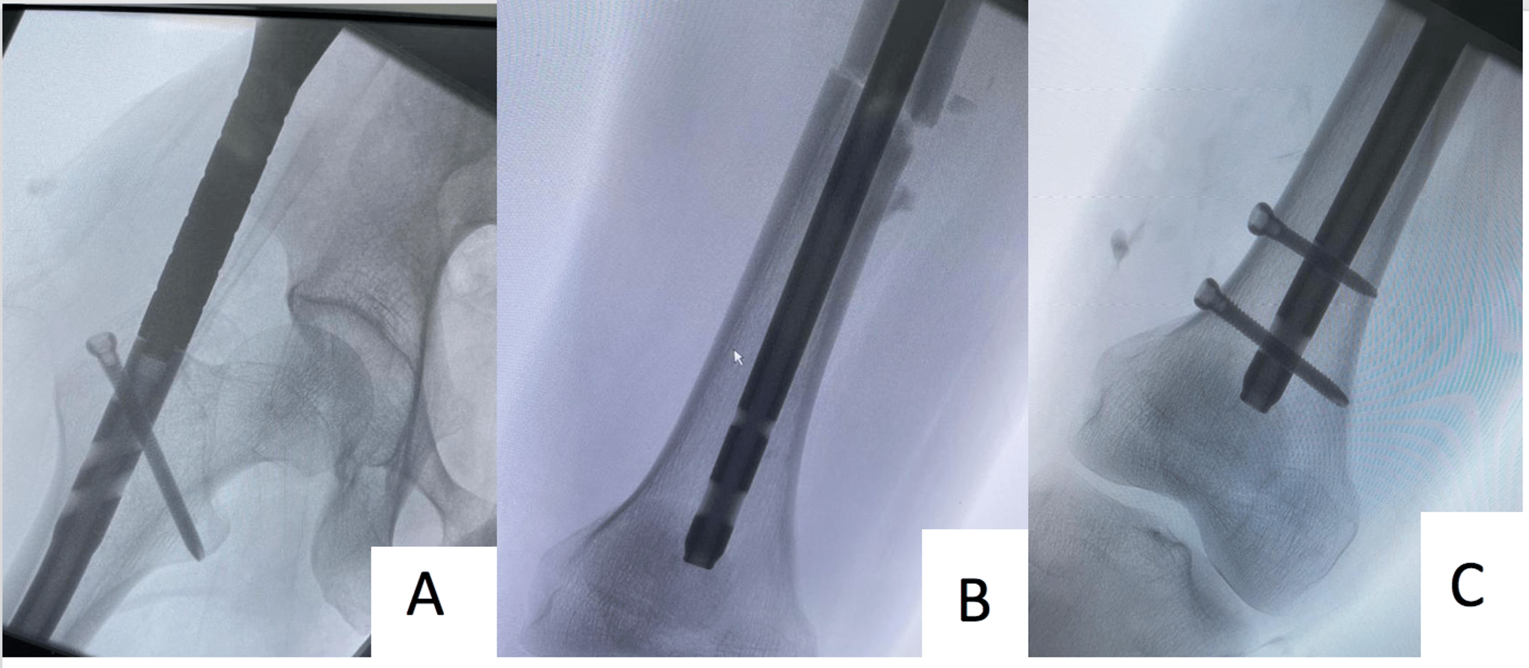 Cureus Ipsilateral Foot Drop After Leg Traction on Fracture Table for