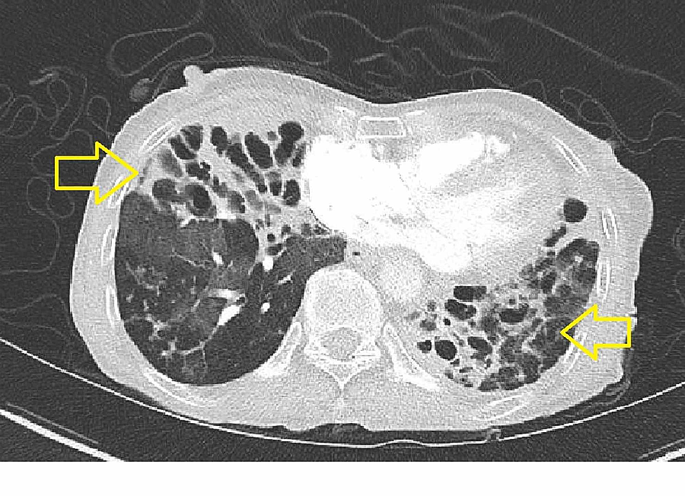 Computed-tomography-chest-with-IV-contrast-(axial)-demonstrating-bilateral-cystic-bronchiectasis-with-fibrosis-indicative-of-chronic,-advanced-M.-abscessus-infection.
