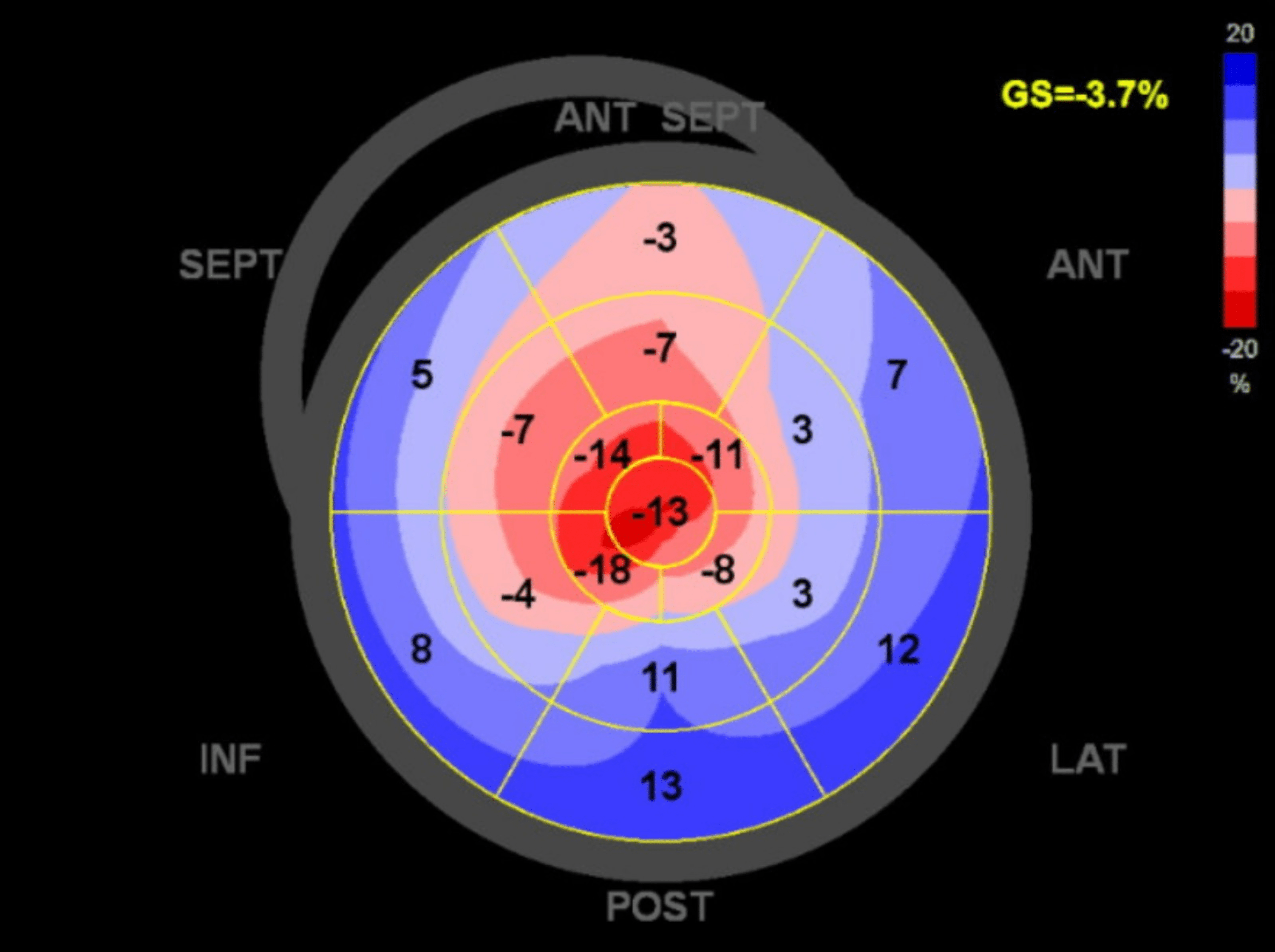 Cureus | Failure to Confirm Typical Echocardiographic Findings of ...