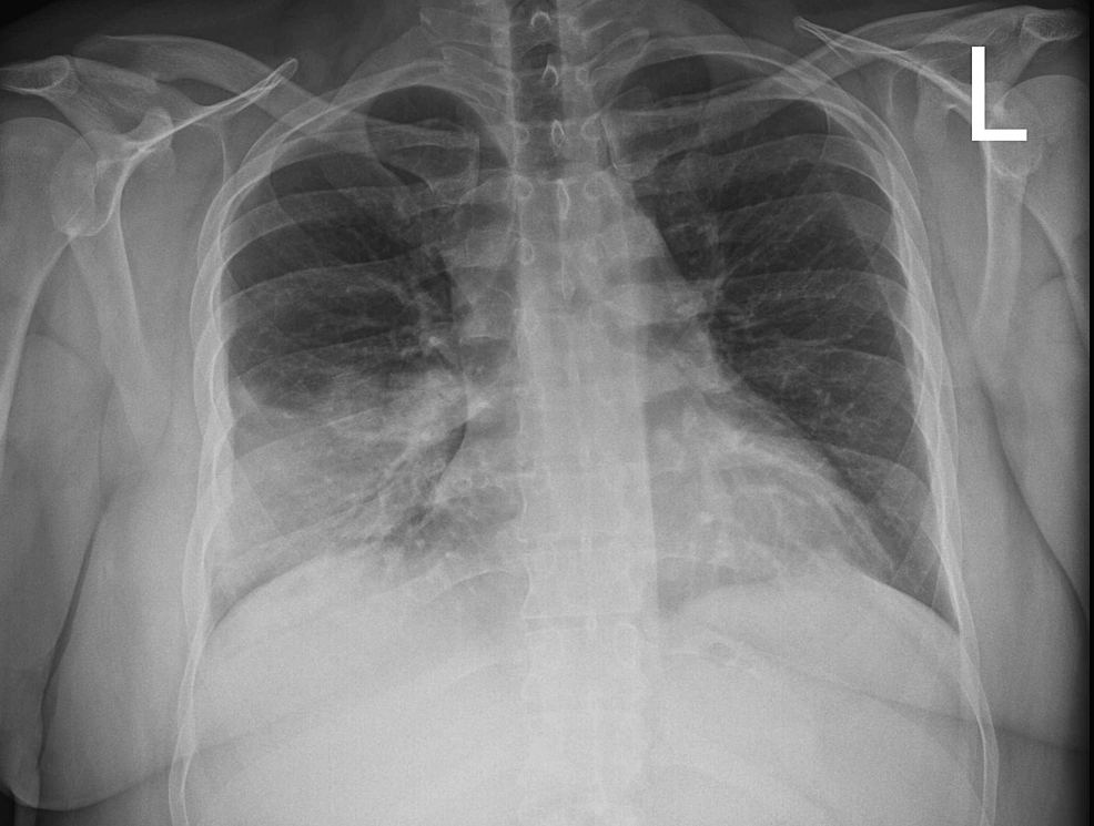 a-rare-case-of-community-acquired-pneumonia-only-presenting-with