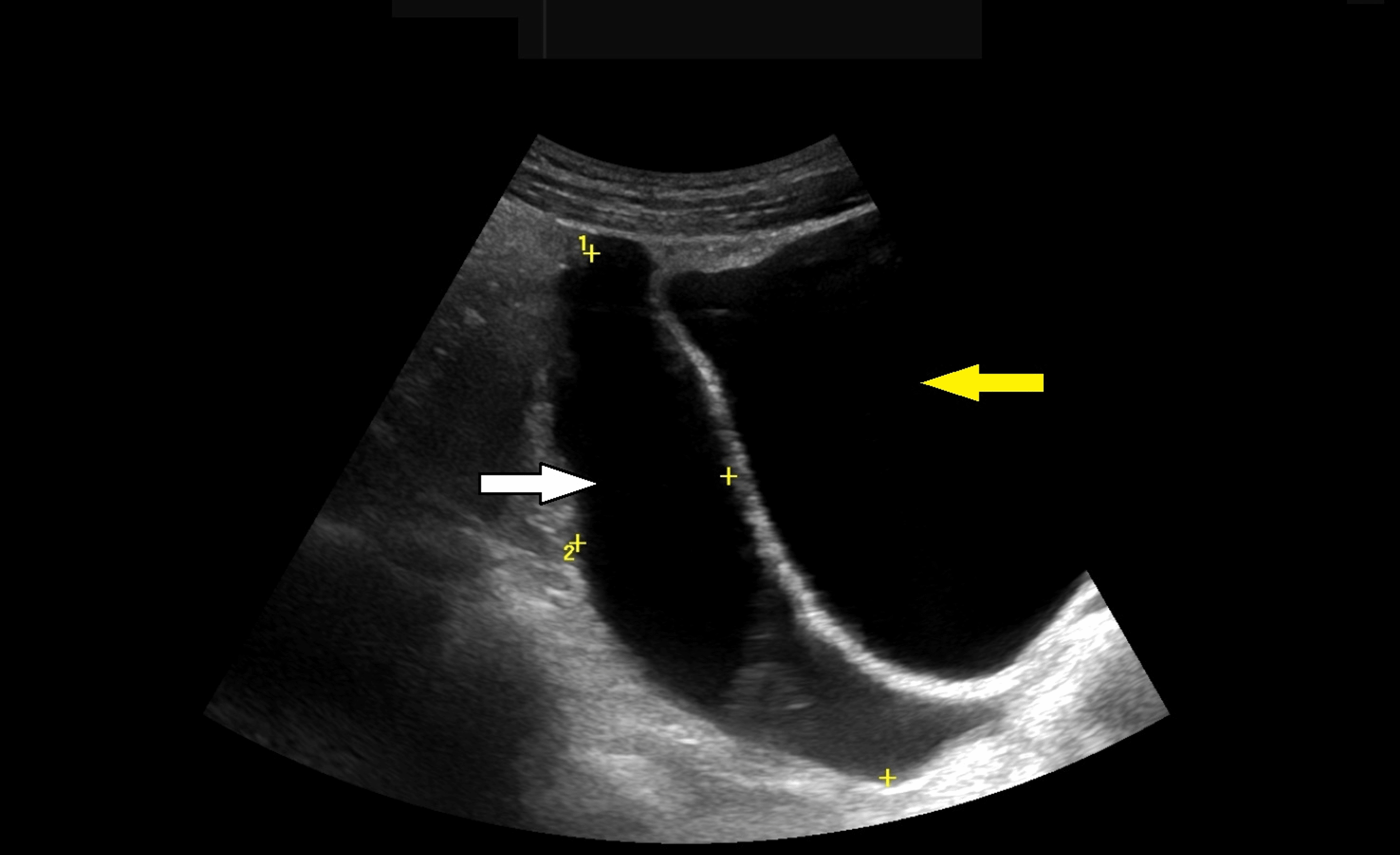 Idiopathic Spontaneous Intraperitoneal Haemorrhage (ISIH) A Diagnostic