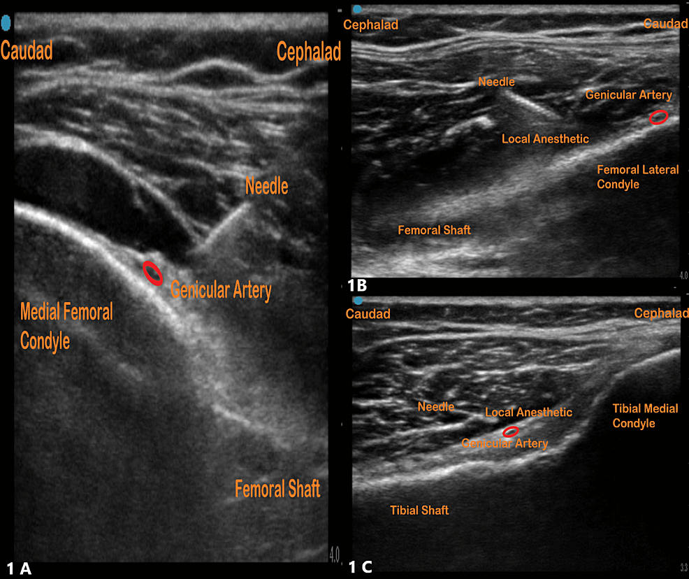 Lower Extremity Nerve Blocks Poster (in)