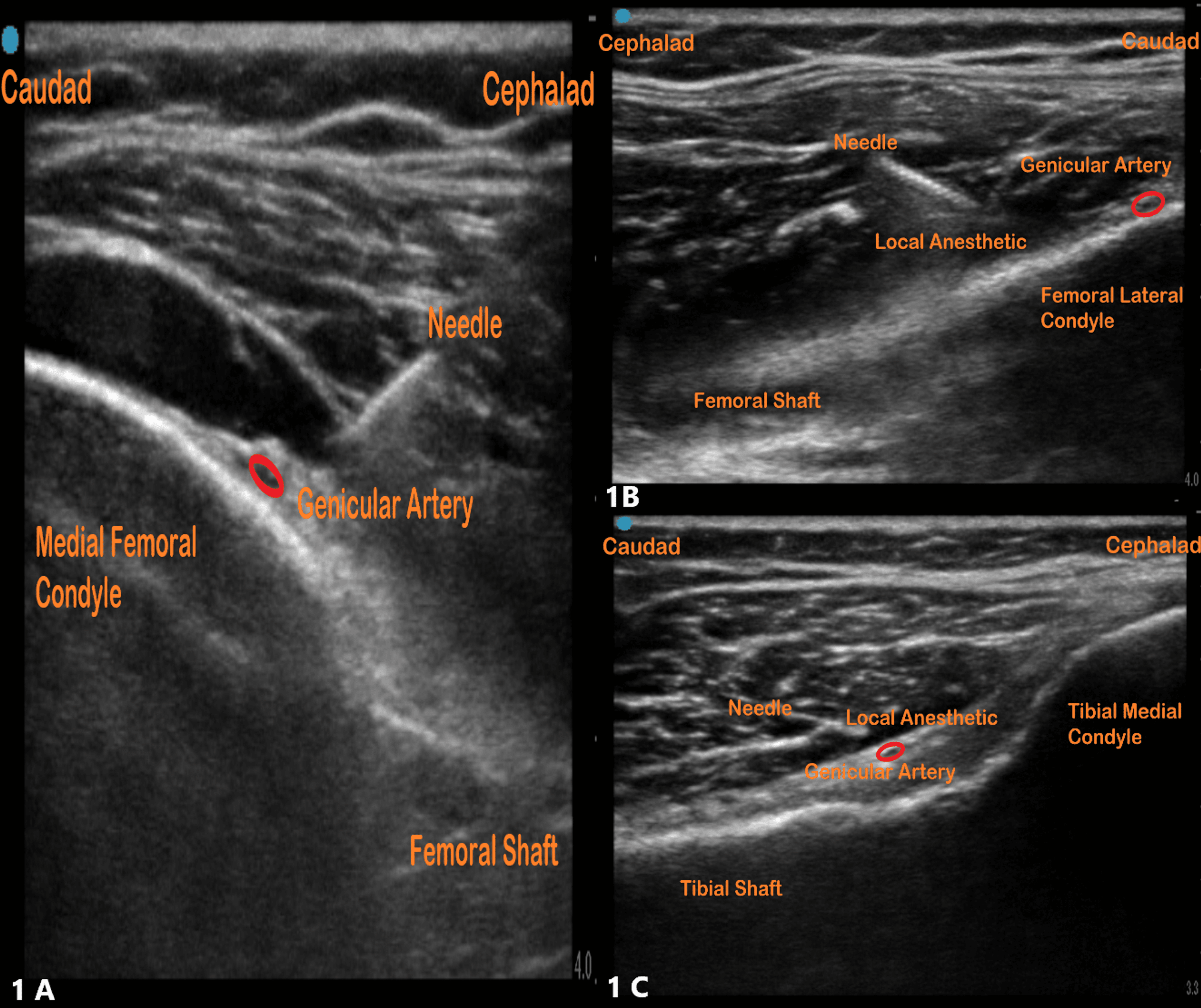 Genicular Nerves Block Medical Ultrasound Knee - vrogue.co