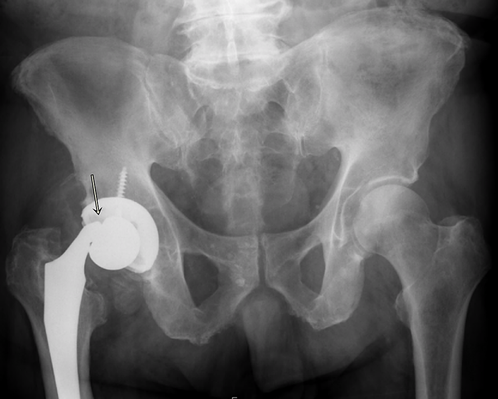 Cureus A Case Report and Literature Review to Aid in the Management