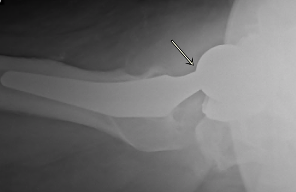 Cureus A Case Report and Literature Review to Aid in the Management