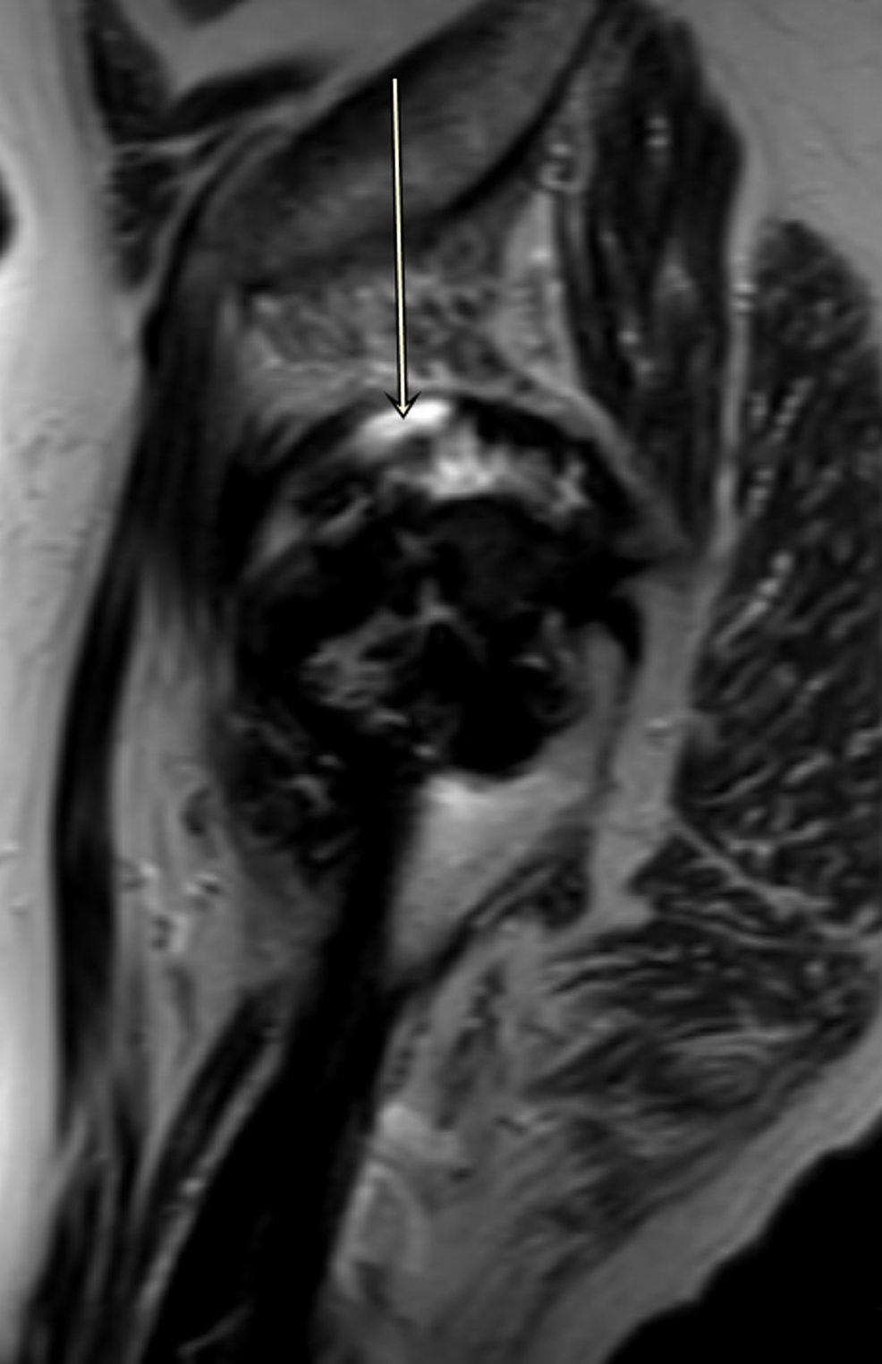 Cureus A Case Report and Literature Review to Aid in the Management